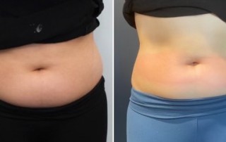 slimming cryoskin treatment on a womans stomache