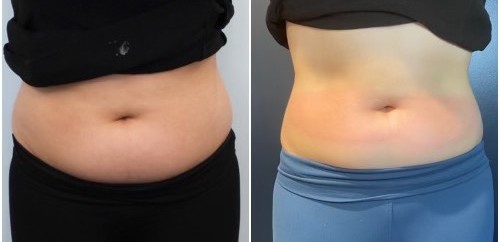 slimming cryoskin treatment on a womans stomache