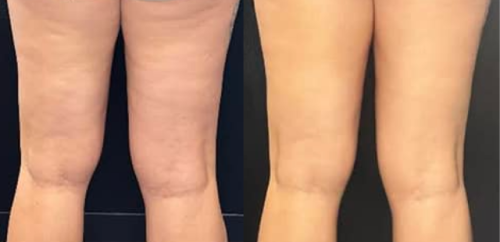 Cryoskin Before and After treatment on a woman legs