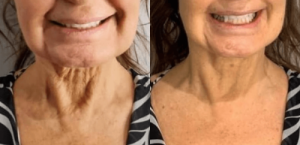 Croskin Facial Before and After