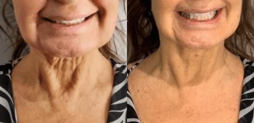 Cryoskin Facial Results by The Body Bar 