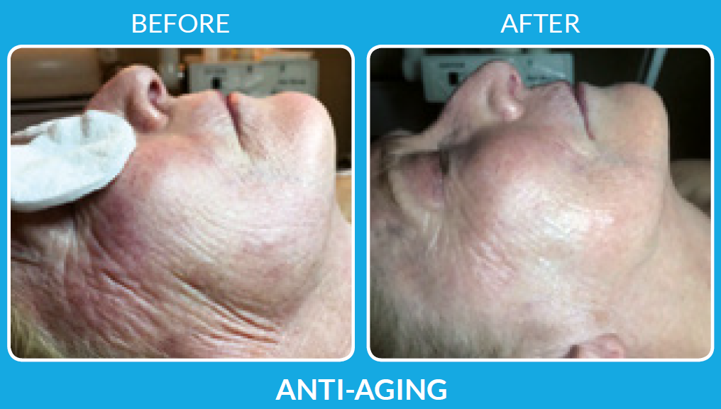 ProCell Pittsburgh for Anti-aging
