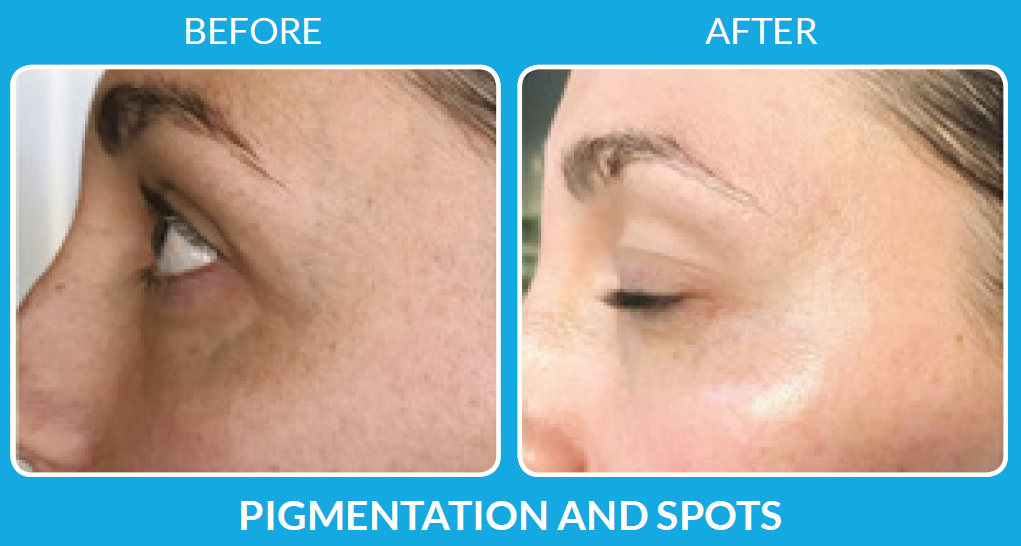 ProCell for Pigmentation