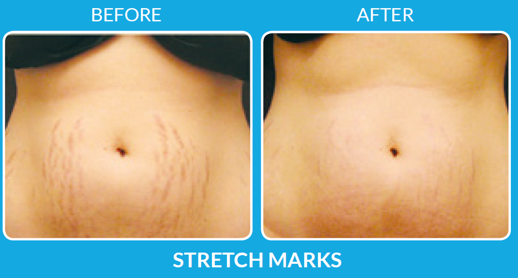 ProCell Therapy Pittsburgh Before and After