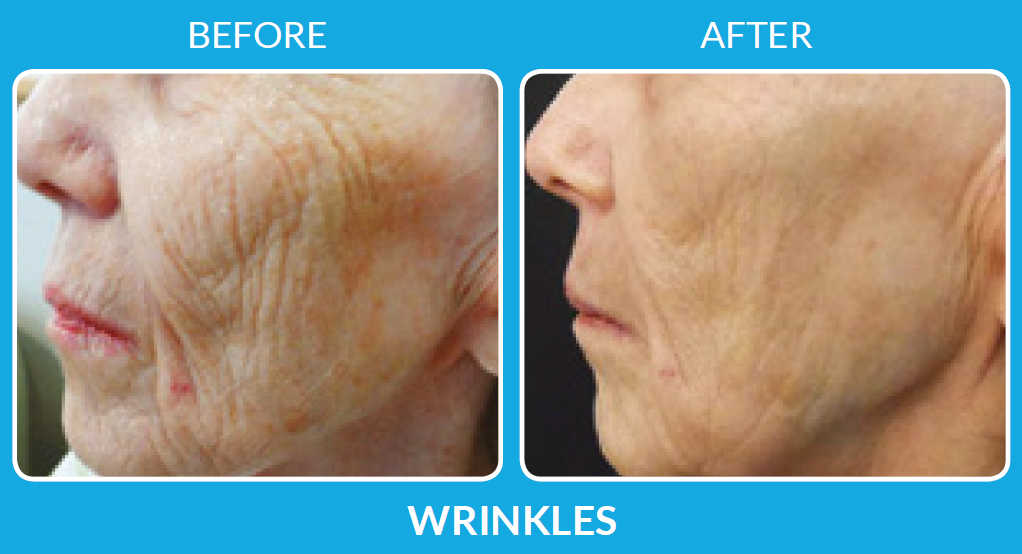 Before and After ProCell Wrinkle therapy