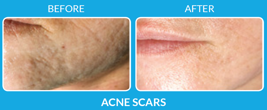 acne scar treatment with ProCell