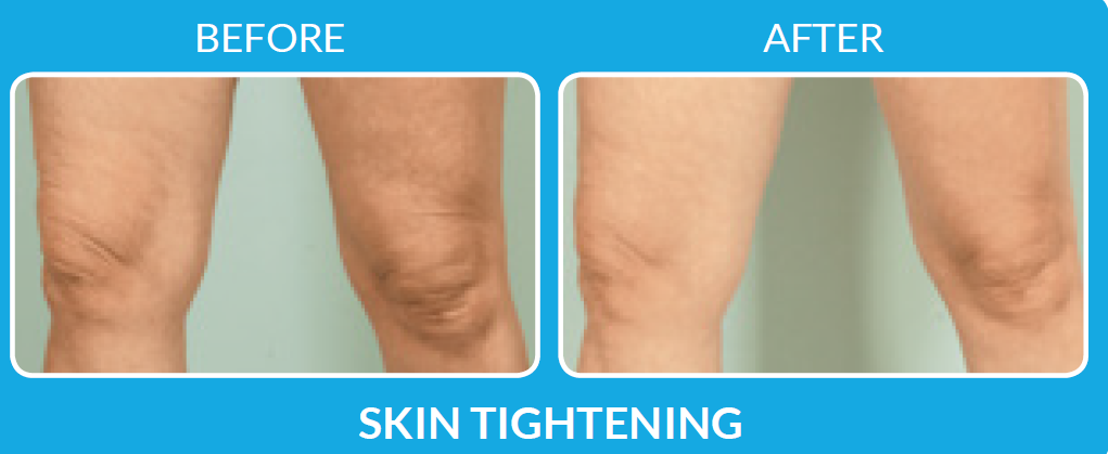 skin tightening with ProCell